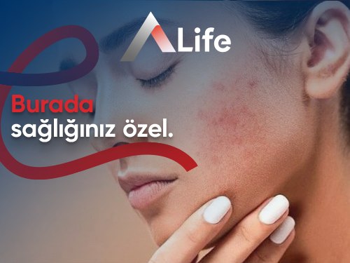 Salisilik Asit Nedir? Salisilik Asit Ne İşe Yarar?